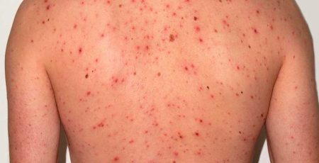 alerta-epidemiologica-por-sarampion-en-mexico-chihuahua-con-mas-casos.jpeg Alerta epidemiológica por sarampión en México, Chihuahua con más casos