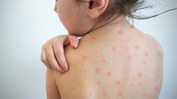 measles-su19.jpg